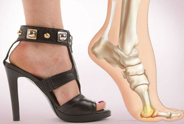 Tác hại không ngờ tới của giày cao gót