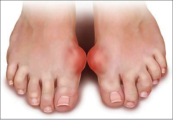 Cách phòng chống bệnh gút với máy chạy bộ điện