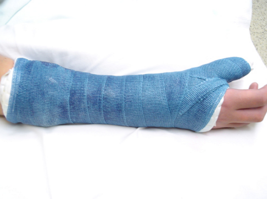Chữa trị và phục hồi chức năng cho người gãy xương