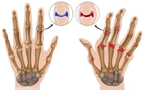 Sinh hoạt thế nào phù hợp với người bị viêm khớp dạng thấp